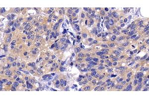 Detection of CASP9 in Human Lymphoma Tissue using Polyclonal Antibody to Caspase 9 (CASP9)