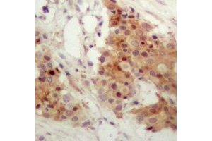 Immunohistochemical analysis of IRF3 (pS385) staining in human breast cancer formalin fixed paraffin embedded tissue section.