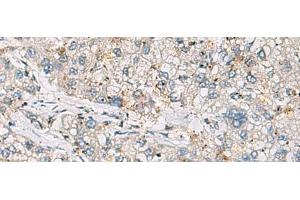 Immunohistochemistry of paraffin-embedded Human liver cancer tissue using ARIH1 Polyclonal Antibody at dilution of 1:30(x200) (ARIH1 Antikörper)