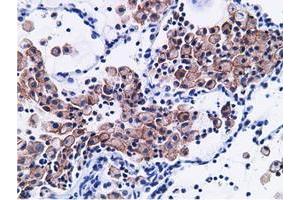 Immunohistochemical staining of paraffin-embedded Adenocarcinoma of Human breast tissue using anti-CD80 mouse monoclonal antibody. (CD80 Antikörper)
