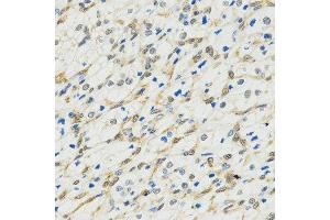 Immunohistochemistry of paraffin-embedded human kidney cancer tissue using MYSM1 antibody at dilution of 1:200 (x400 lens). (MYSM1 Antikörper  (C-Term))