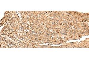 Immunohistochemistry of paraffin-embedded Human liver cancer tissue using RPS12 Polyclonal Antibody at dilution of 1:70(x200) (RPS12 Antikörper)