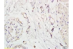 Formalin-fixed and paraffin embedded human colon carcinoma labeled with Anti-SLC5A8 Polyclonal Antibody, Unconjugated (ABIN762521) at 1:200 followed by conjugation to the secondary antibody and DAB staining. (SLC5A8 Antikörper  (AA 301-400))