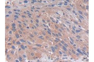DAB staining on IHC-P; Samples: Human Lung Tissue (PCSK5 Antikörper  (AA 115-454))