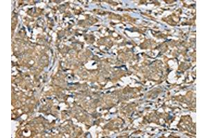 The image on the left is immunohistochemistry of paraffin-embedded Human breast cancer tissue using ABIN7192325(SERPINA11 Antibody) at dilution 1/35, on the right is treated with synthetic peptide. (SERPINA11 Antikörper)