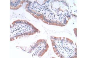IHC-P analysis of Human Stomach Cancer Tissue, with DAB staining. (GLTP Antikörper  (AA 2-209))