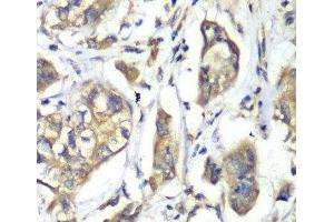 Immunohistochemistry of paraffin-embedded Human liver cancer using NFS1 Polyclonal Antibody at dilution of 1:100 (40x lens). (NFS1 Antikörper)
