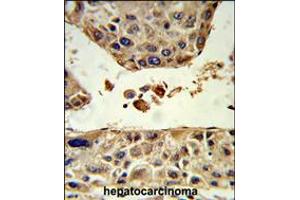 Formalin-fixed and paraffin-embedded human hepatocarcinoma reacted with HPD Antibody , which was peroxidase-conjugated to the secondary antibody, followed by DAB staining.