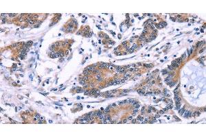 Immunohistochemistry of paraffin-embedded Human colon cancer using SYT4 Polyclonal Antibody at dilution of 1:60 (SYT4 Antikörper)
