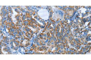 Immunohistochemistry of paraffin-embedded Human thyroid cancer tissue using AGL Polyclonal Antibody at dilution 1:30 (AGL Antikörper)