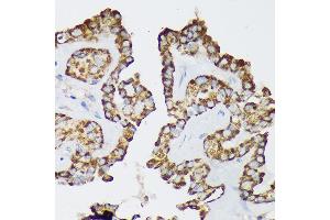 Immunohistochemistry of paraffin-embedded Human thyroid cancer using Septin 8 Rabbit pAb (ABIN7265350) at dilution of 1:100 (40x lens). (Septin 8 Antikörper  (AA 348-427))