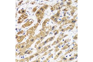 Immunohistochemistry of paraffin-embedded human liver cancer using HAPLN1 antibody. (HAPLN1 Antikörper)