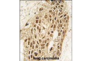 Formalin-fixed and paraffin-embedded human lung carcinoma tissue reacted with Dnmt3a antibody (N-term R46) , which was peroxidase-conjugated to the secondary antibody, followed by DAB staining. (DNMT3A Antikörper  (N-Term))