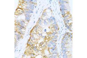 Immunohistochemistry of paraffin-embedded human colon carcinoma using BMP2 antibody at dilution of 1:100 (40x lens). (BMP2 Antikörper)