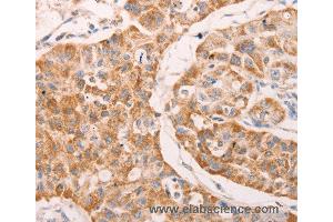 Immunohistochemistry of Human lung cancer using GNA11 Polyclonal Antibody at dilution of 1:40 (GNA11 Antikörper)