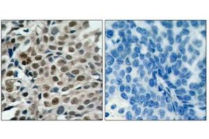Immunohistochemical analysis of paraffin-embedded human breast carcinoma tissue using FKHRL1 (phospho-Ser253) antibody. (FOXO3 Antikörper  (pSer253))
