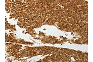 The image on the left is immunohistochemistry of paraffin-embedded Human liver cancer tissue using ABIN7192598(SOCS7 Antibody) at dilution 1/30, on the right is treated with synthetic peptide. (SOCS7 Antikörper)