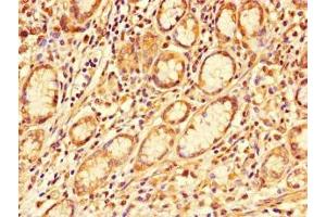Immunohistochemistry of paraffin-embedded human gastric cancer using ABIN7163856 at dilution of 1:100 (GALNT11 Antikörper  (AA 420-606))