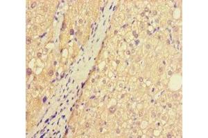Immunohistochemistry of paraffin-embedded human liver cancer using ABIN7144175 at dilution of 1:100