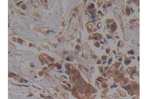Detection of PKCi in Human Breast cancer Tissue using Polyclonal Antibody to Protein Kinase C Iota (PKCi) (PKC iota Antikörper  (AA 375-596))