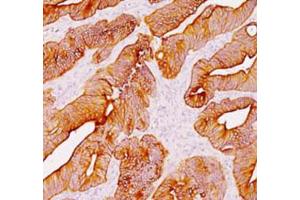 Immunohistochemical staining (Formalin-fixed paraffin-embedded sections) analysis of human colon with Pan Cytokeratin monoclonal antibody, clone AE1 + AE3  at 1:200 using peroxidase-conjugate and DAB chromogen. (Keratin 77 Antikörper)