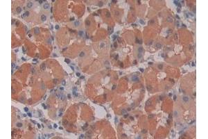 Detection of IL28A in Human Stomach cancer Tissue using Monoclonal Antibody to Interleukin 28A (IL28A) (IL28A Antikörper  (AA 26-200))