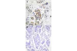 Immunohistochemical staining (Formalin-fixed paraffin-embedded sections) of human breast cancer tissue with ITGB4 (phospho Y1510) polyclonal antibody  without blocking peptide (A) or preincubated with blocking peptide (B) under 1:50-1:100 dilution. (Integrin beta 4 Antikörper  (pTyr1510))