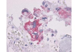 Anti-PTHR / PTHR1 antibody IHC of human Bone, Giant Cell Tumor. (PTH1R Antikörper  (N-Term))