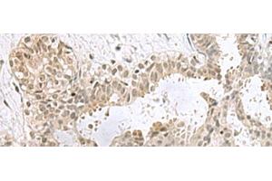 Immunohistochemistry of paraffin-embedded Human breast cancer tissue using PCBD1 Polyclonal Antibody at dilution of 1:60(x200) (PCBD1 Antikörper)