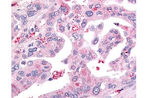 Anti-USP4 / UNP antibody IHC of human Pancreas, Carcinoma. (USP4 Antikörper  (Internal Region))