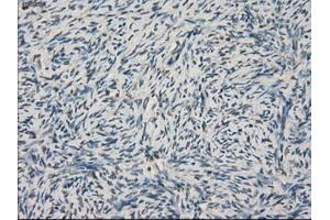 Immunohistochemical staining of paraffin-embedded Adenocarcinoma of colon tissue using anti-LTA4H mouse monoclonal antibody. (LTA4H Antikörper)