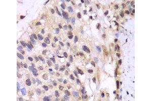 Immunohistochemistry of paraffin-embedded Human lung cancer using PSMA6 Polyclonal Antibody at dilution of 1:100 (40x lens). (PSMA6 Antikörper)