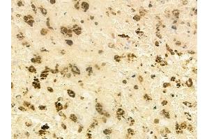 ABIN6265489 and ABIN6277939 at 1/100 staining human melanoma by IHC-P. (T-Bet Antikörper  (Internal Region))