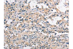 The image on the left is immunohistochemistry of paraffin-embedded Human thyroid cancer tissue using ABIN7190272(CLDN11 Antibody) at dilution 1/25, on the right is treated with synthetic peptide. (Claudin 11 Antikörper)