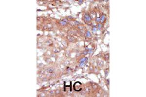 Formalin-fixed and paraffin-embedded human hepatocellular carcinoma tissue reacted with TNK2 polyclonal antibody  , which was peroxidase-conjugated to the secondary antibody, followed by AEC staining. (TNK2 Antikörper  (C-Term))