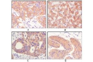 Immunohistochemical analysis of paraffin-embedded human lung squamous cell carcinoma (A),normal hepatocyte (B), colon adenocacinoma? (Cytokeratin 1 Antikörper)