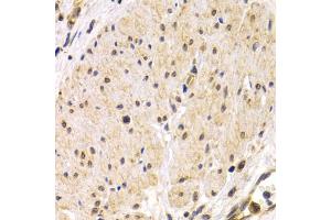 Immunohistochemistry of paraffin-embedded human stomach cancer using TMPRSS2 antibody. (TMPRSS2 Antikörper)