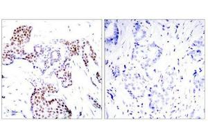 Immunohistochemical analysis of paraffin-embedded human breast carcinoma tissue using Elk1(Phospho-Ser389) Antibody(left) or the same antibody preincubated with blocking peptide(right). (ELK1 Antikörper  (pSer389))