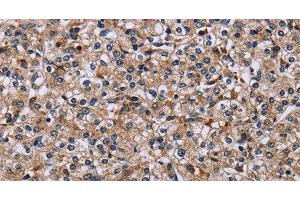 Immunohistochemistry of paraffin-embedded Human prostate cancer using IPO4 Polyclonal Antibody at dilution of 1:50 (Importin 4 Antikörper)