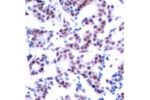 Immunohistochemistry of paraffin-embedded human breast carcinoma using Phospho-JUNB-S259 antibody (ABIN2988088). (JunB Antikörper  (pSer259))