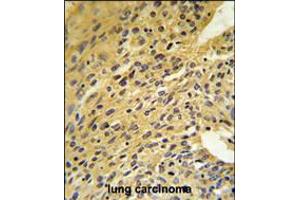 COQ5 Antibody IHC analysis in formalin fixed and paraffin embedded human lung carcinoma followed by peroxidase conjugation of the secondary antibody and DAB staining. (COQ5 Antikörper  (AA 213-241))