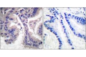 Immunohistochemistry analysis of paraffin-embedded human lung carcinoma tissue, using Caspase 6 (Cleaved-Asp162) Antibody. (Caspase 6 Antikörper  (Cleaved-Asp162))