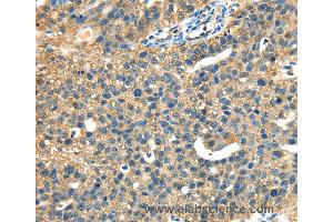 Immunohistochemistry of Human ovarian cancer using DHCR24 Polyclonal Antibody at dilution of 1:40 (Seladin 1 Antikörper)