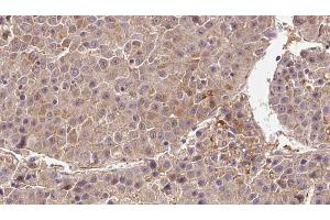 ABIN6273354 at 1/100 staining Human liver cancer tissue by IHC-P. (DIRAS3 Antikörper  (C-Term))