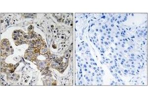 Immunohistochemistry analysis of paraffin-embedded human breast carcinoma tissue, using KCNK15 Antibody.
