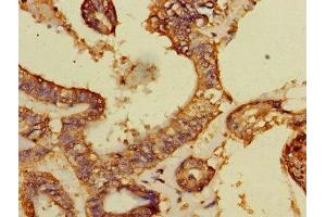 Immunohistochemistry of paraffin-embedded human endometrial cancer using ABIN7149526 at dilution of 1:100 (DCAF8 Antikörper  (AA 1-135))