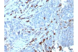 Formalin-fixed, paraffin-embedded human Tumor stained with IgM Recombinant Rabbit Monoclonal Antibody (IGHM/3135R). (Rekombinanter IGHM Antikörper)