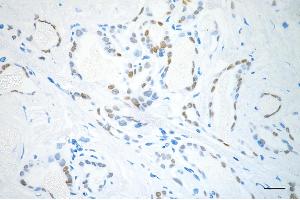 Immunohistochemistry was performed on paraffin-embedded human papillary thyroid carcinoma using NK2 homeobox 1 antibody (ABIN7799607), 1:200). (Rekombinanter NKX2-1 Antikörper)