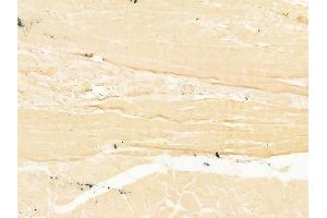 ABIN6265212 and ABIN6273016 at 1/100 staining human tongue carcinoma by IHC-P.