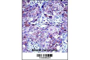 MMP13 Antibody immunohistochemistry analysis in formalin fixed and paraffin embedded human breast carcinoma followed by peroxidase conjugation of the secondary antibody and DAB staining. (MMP13 Antikörper  (AA 253-282))